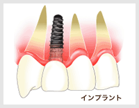 インプラントとは？