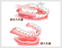 入れ歯とは？