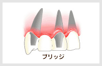 ブリッジとは？